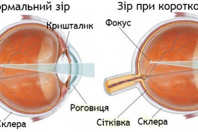 Аплікаційна терапія Ляпко при захворюваннях органів зору