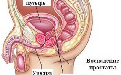Prostatitis vezikulita